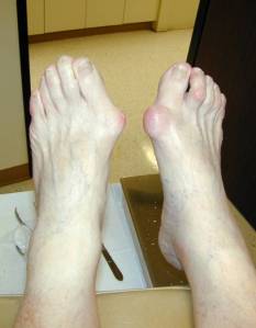 bunion_02