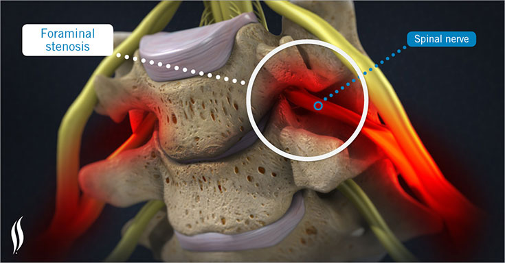 foraminal-stenosis--3d-render