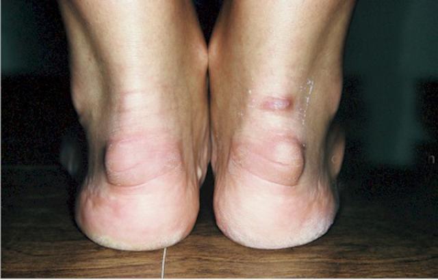 pump bump haglunds_deformity_mod